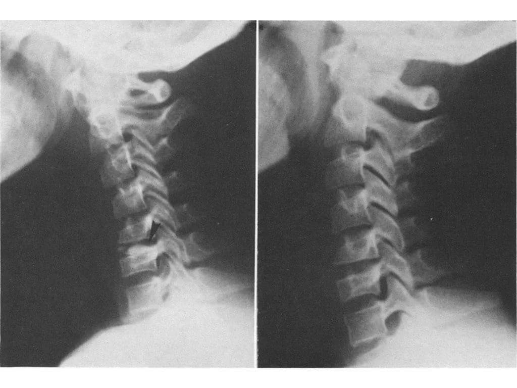 Is conservative therapy an effective option for treating PIDC?