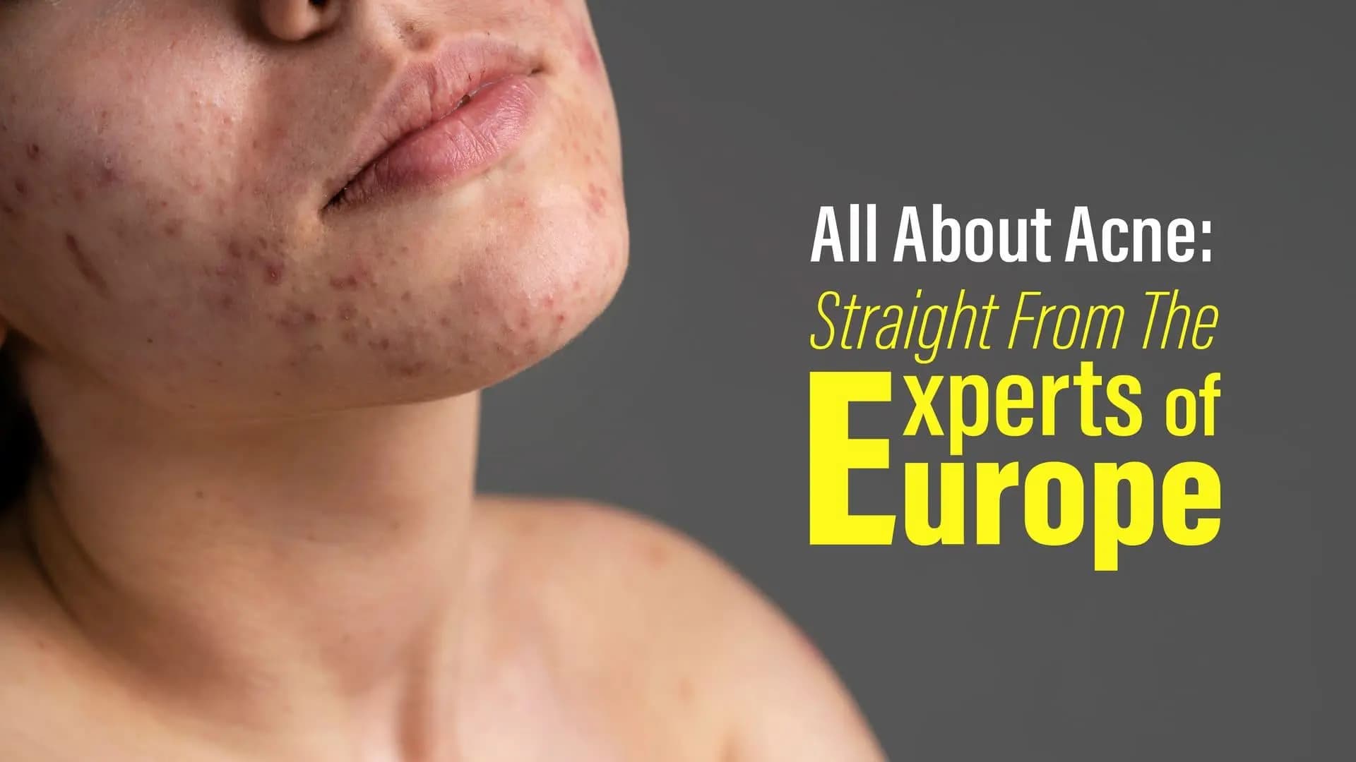 All About Acne: Straight From The Experts of Europe
