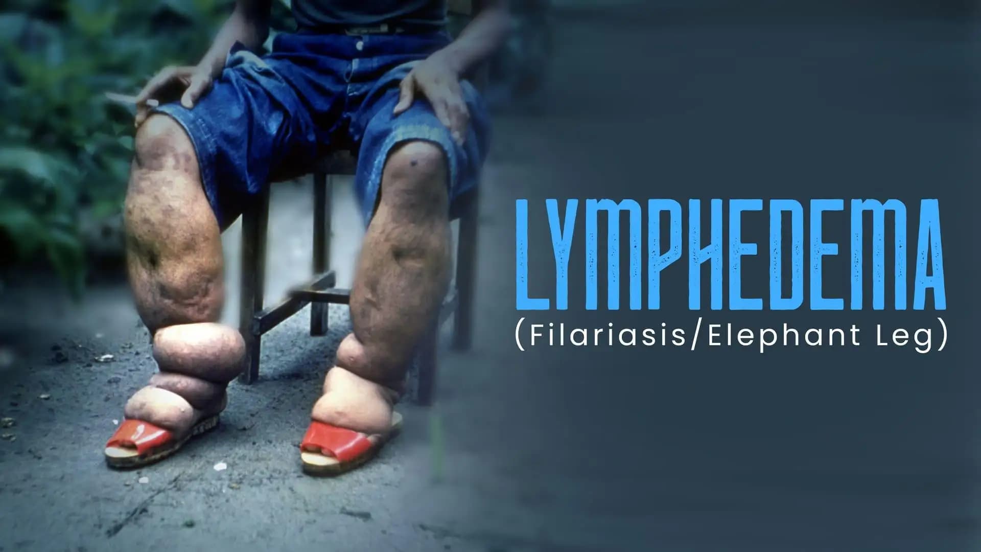 Lymphedema(Filariasis/Elephant Leg)