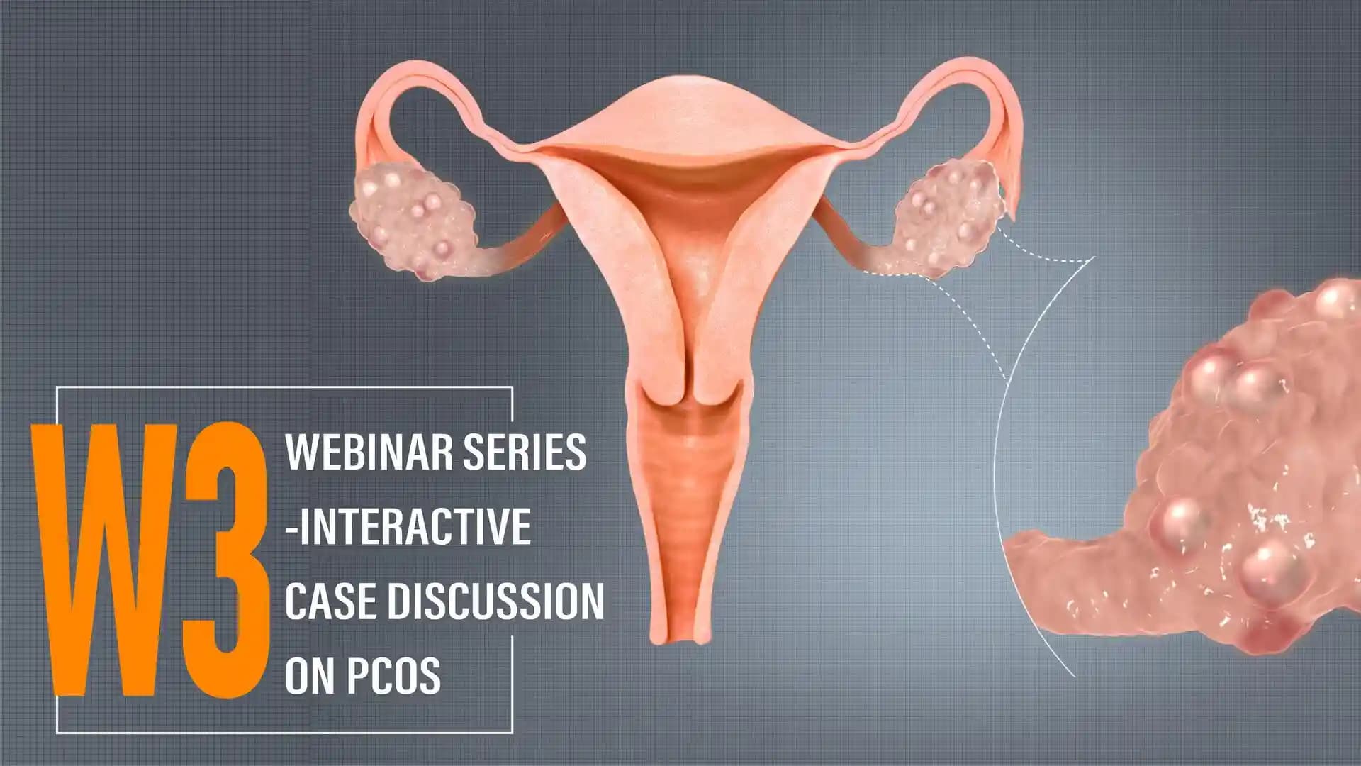 W3 Webinar Series- Interactive Case Discussion on PCOS