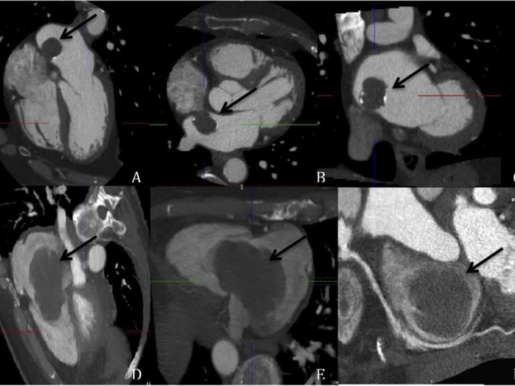 Efficacy and safety of intravenous thrombolysis in Acute Ischemic Stroke