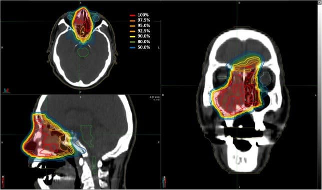 Embryonal Rhabdomyosarcoma: New Views on Rapid Recurrence & Multimodal Care