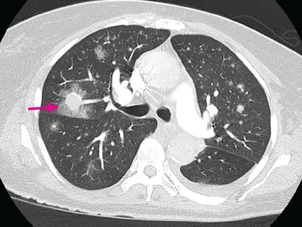 Efficacy and safety of voriconazole for IPA in patients with SLD