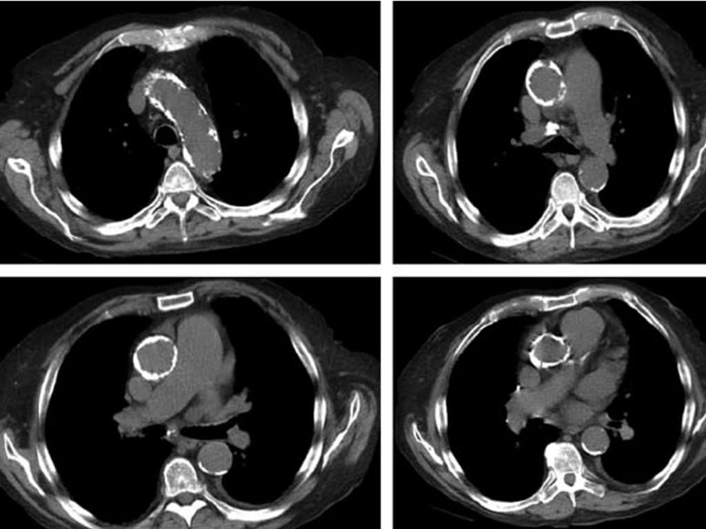 TAVR in PA Patients: Clinical Outcomes and Aortic Calcification Patterns
