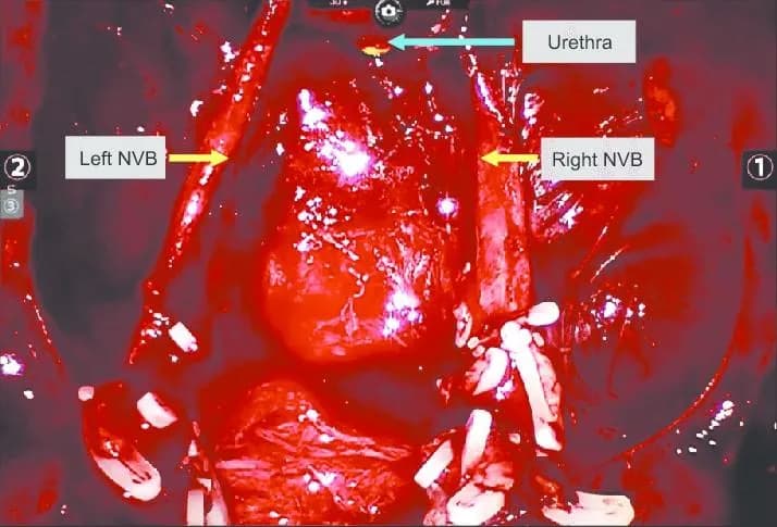 Association of nerve-sparing grading in RARP and trifecta outcome