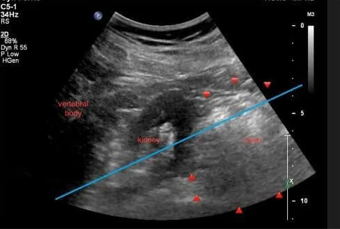 Ultrasound-guided PCNL: an alternative option for retrorenal colon cases
