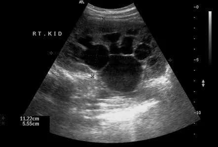 Etiology of pelviureteric junction obstruction: Current evidence