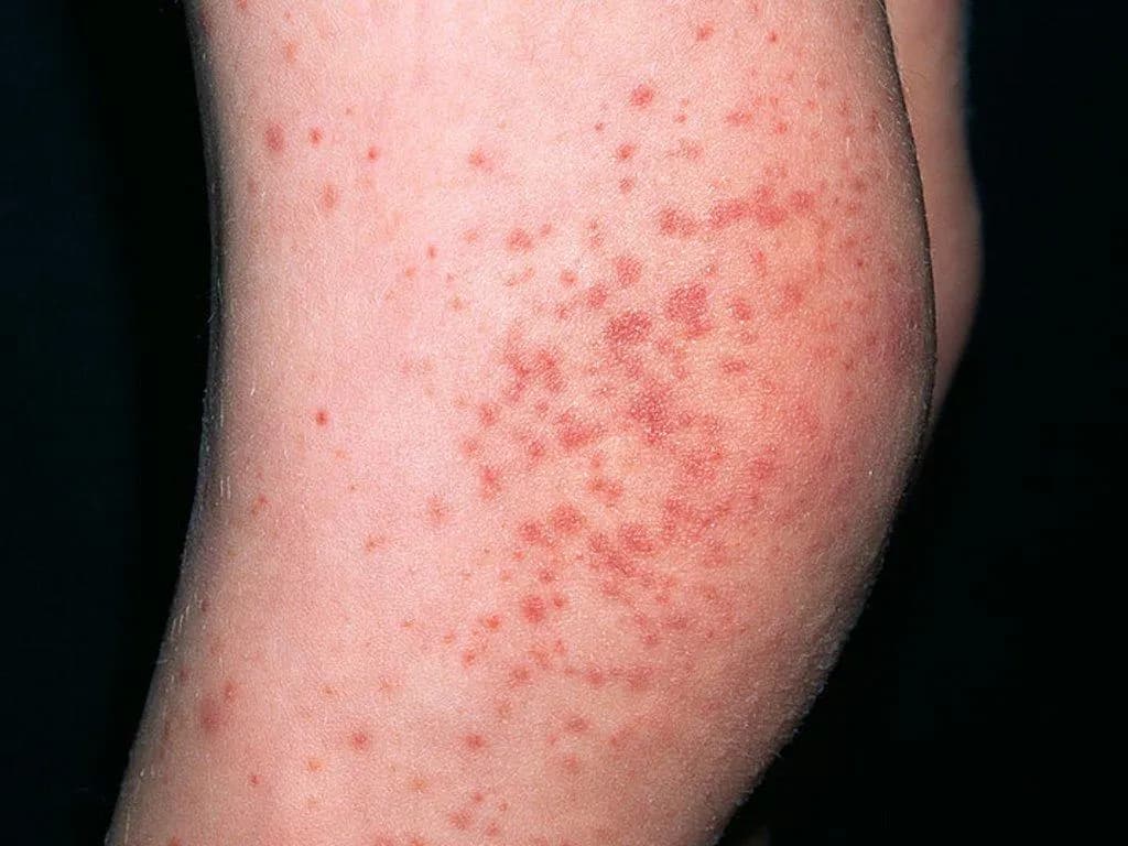 Laboratory indices and pediatric IgAV recurrence: Linked?