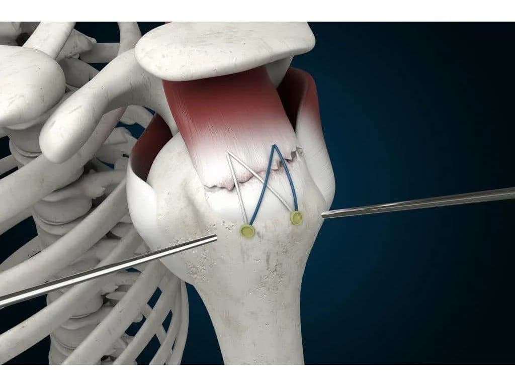 Low resilience is linked with decreased PROs following ARCR