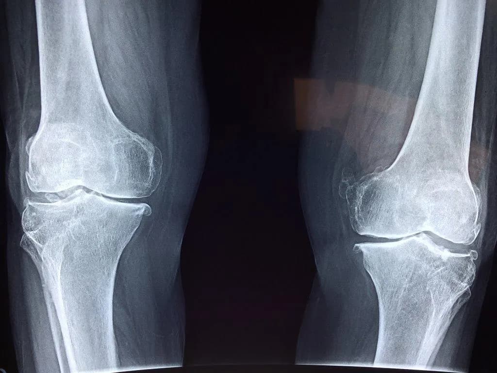 Metabolic factors and early-stage radiographic KOA: How are they linked?