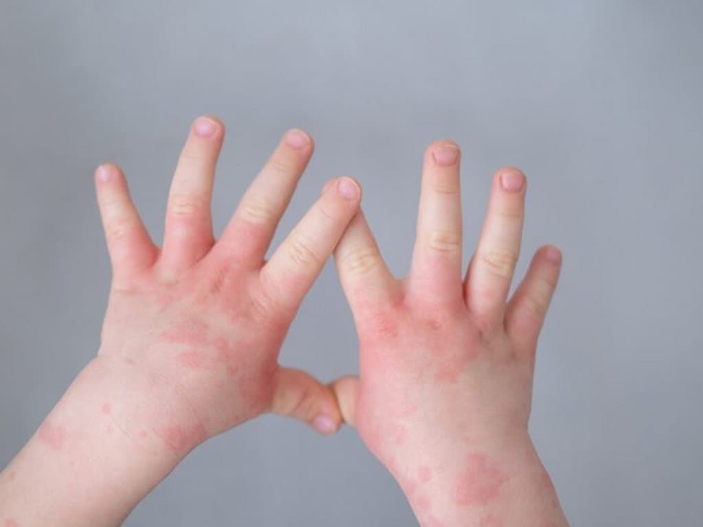 Effects of childhood atopic dermatitis on adulthood stigma and burden