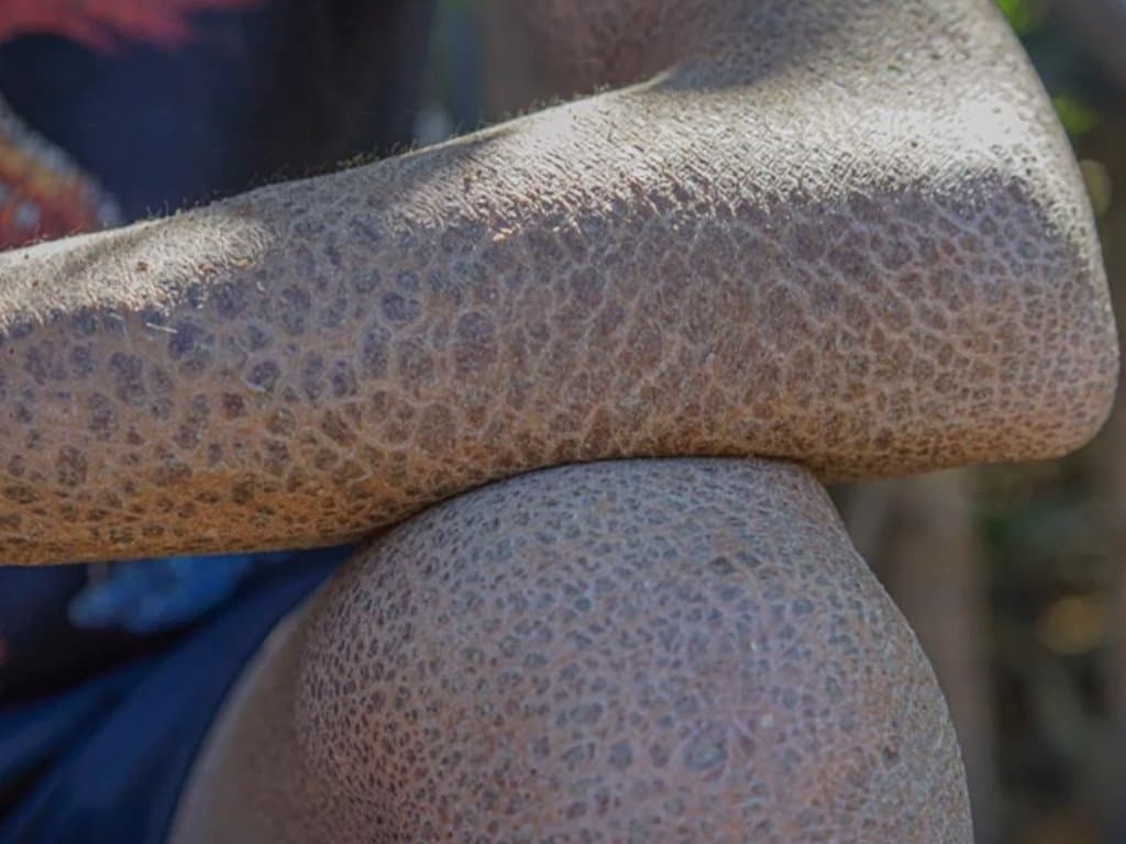 Epidemiology & clinical attributes of non-syndromic congenital ichthyosis