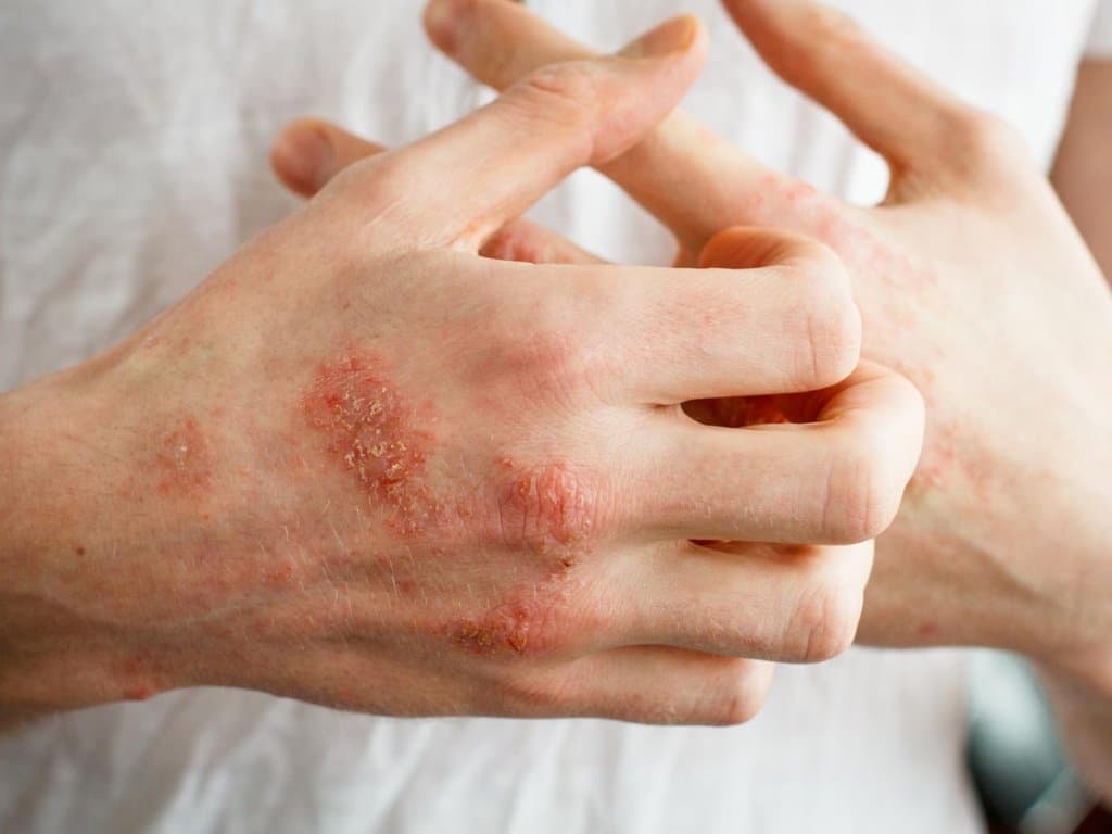 Assessing the real-world burden of Atopic Dermatitis: ESSENTIAL AD Study