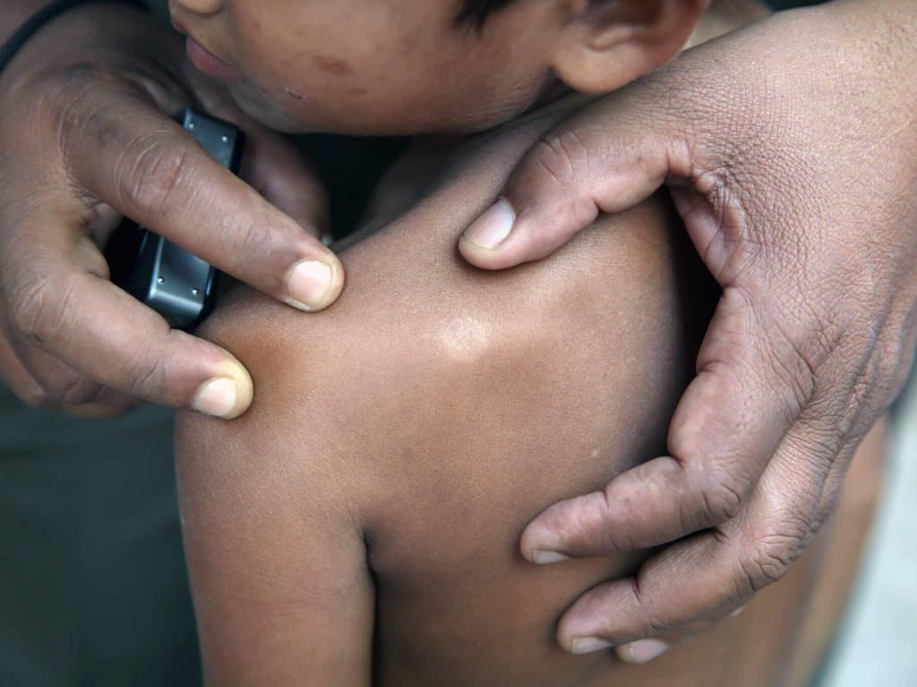 Post-elimination era: How does leprosy affect children and adolescents?