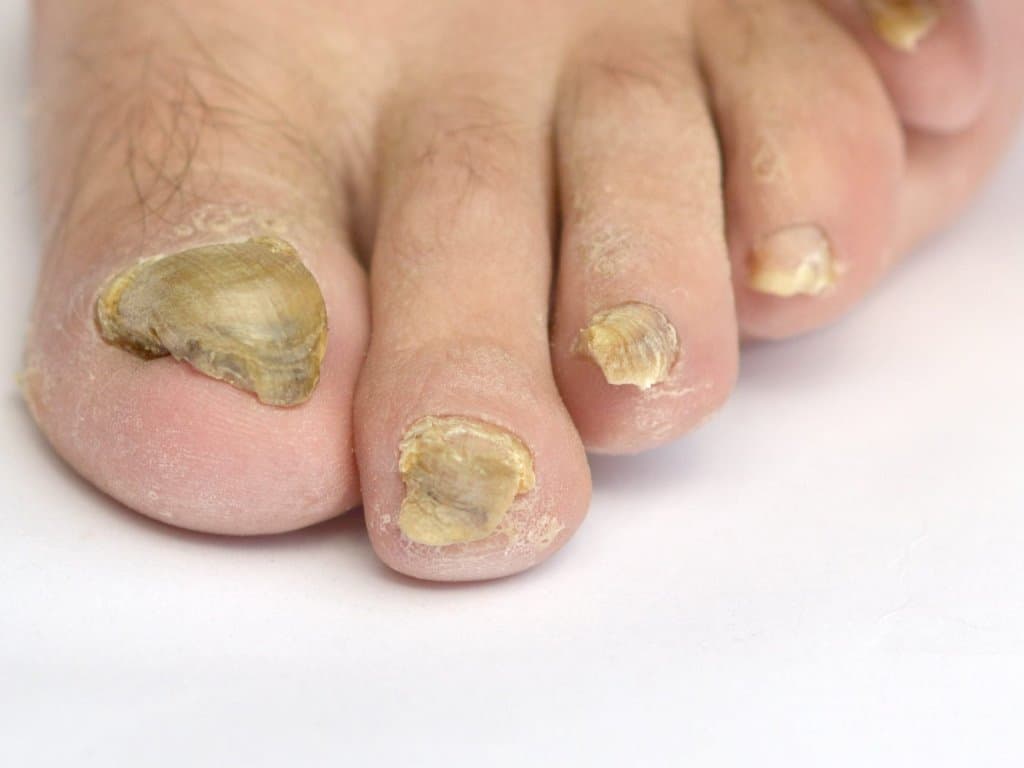 Fosravuconazole: an effective treatment for onychomycosis in the elderly
