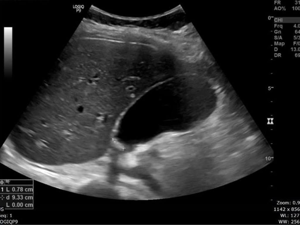 Gallbladder distention on ultrasound for cholecystitis