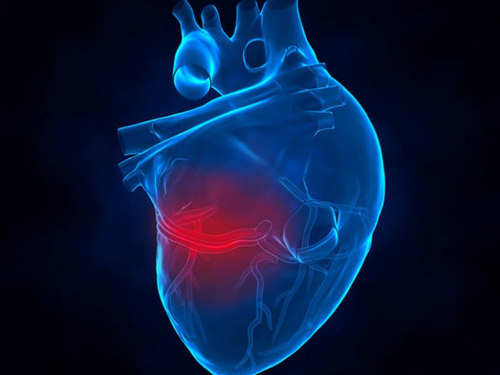 Tracheostomy in acute myocardial infarction patients